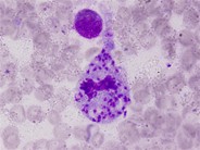 Leishmaniasis in bone marrow aspirate - 2.