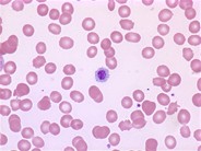 Giant platelet - 1.