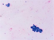 Perl’s stained-urine of an adult male who is a known case of PNH since over 10 years - 1.