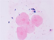 Perl’s stained-urine of an adult male who is a known case of PNH since over 10 years - 2.