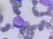 LE cells in BMA, another image