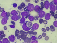 AML Blast with Hemophagocytosis