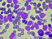 AML Blast with Hemophagocytosis