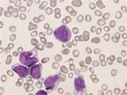 Promyelocytes with Auer rods - 01