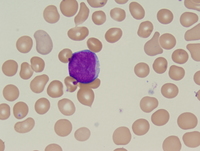 Acute myeloid leukemia with myelodysplasia related changes-peripheral blood