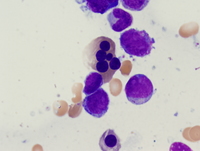 Acute myeloid leukemia with myelodysplasia related changes 2