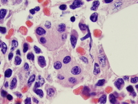 Acute myeloid leukemia with myelodysplasia related changes 4