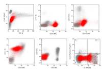 Acute myeloid leukemia with myelodysplasia related changes 5