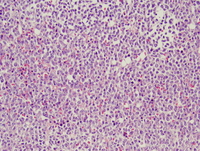 Mixed-phenotype-acute-leukemia-with-t922q34q2112-BCRABL-Bone-Marrow--Biopsy