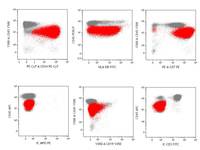 Acute undifferentiated leukemia-Flow cytometry