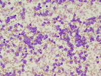 Acute undifferentiated leukemia