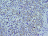 Myeloid sarcoma