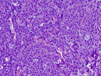 Myeloid-sarcoma