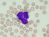 Acute myeloid leukemia with mutated NPM1