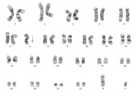 Acute-myeloid-leukemia-with-myelodysplasia-related-changes
