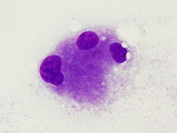 Acute-myeloid-leukemia-with-myelodysplasia-related-changesBM-aspirate