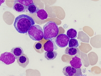 Acute-myeloid-leukemia-with-myelodysplasia-related-changes-PB-2