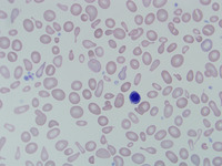 Congenital sideroblastic anemia peripheral blood