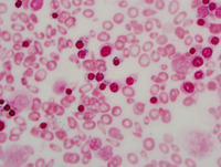 Congenital sideroblastic anemia iron stain