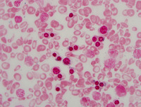 Congenital sideroblastic anemia iron stain