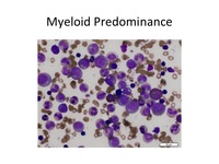 Diamond-Blackfan-Anemia-Aspirate