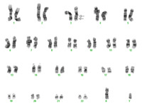 AML-with-inv3q21q262-cytogenetics