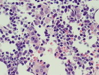 AML-with-inv3q21q262-Biopsy-higher-power