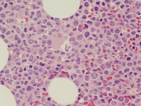 Therapyrelated-myeloid-neoplasm-Acute-myeloid-leukemia
