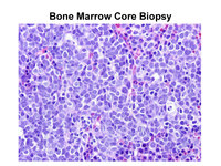 Acute Megakaryoblastic Leukemia Biopsy