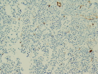 Myeloid leukemia associated with Down syndrome 5