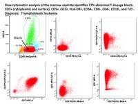 T-cell-ALL-Flow-Cytometry