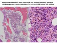 Paroxysmal nocturnal hemoglobinuria (PNH)Biopsy