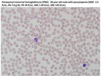 Paroxysmal nocturnal hemoglobinuria (PNH) Peripheral smear