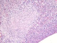 Hematolymphoid neoplasm with PDGFRA rearrangement 1