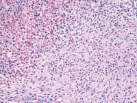 Hematolymphoid neoplasm with PDGFRA rearrangement 2