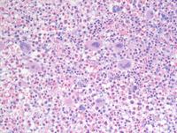 Hematolymphoid neoplasm with PDGFRA rearrangement 4