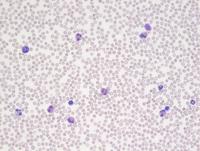 Hematolymphoid neoplasm with PDGFRA rearrangement 7