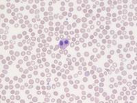 Hematolymphoid neoplasm with PDGFRA rearrangement 8