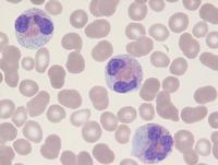 Hematolymphoid neoplasm with PDGFRA rearrangement 9