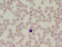 Post-polycythemic myelofibrosis, peripheral blood 2