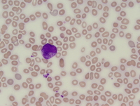 Post-polycythemic myelofibrosis, peripheral blood 3