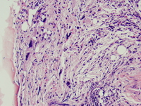 Post-polycythemic myelofibrosis, bone marrow core 2