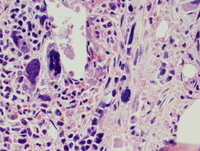 Post-polycythemic myelofibrosis, bone marrow core 3