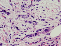 Post-polycythemic myelofibrosis, bone marrow core 4