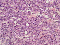 Polycythemia vera (PV), polycythemic phase, core biopsy 1