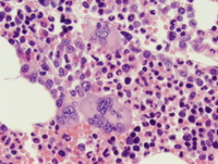 Polycythemia vera (PV), polycythemic phase, core biopsy 3