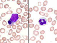 Refractory anemia with excess blasts 1 (RAEB1) 1