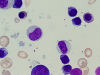 Refractory anemia with excess blasts -1 (RAEB-1) 3