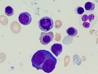 Refractory anemia with excess blasts -1 (RAEB-1) 5