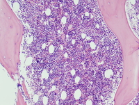 Refractory anemia with excess blasts -1 (RAEB-1) 6